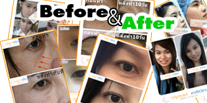 รูปก่อนทำ-หลังทำ ,เสริมจมูก นครสวรรค์